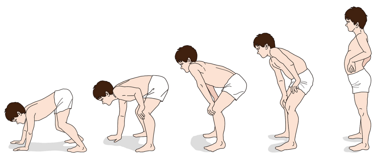 ガワーズ徴候を示す子どもの動作を順に描いたイラスト。床に手をついて四つ這いの姿勢から、徐々に手を膝に当てて体を支えながら起き上がり、最後は腰に手を当てて直立しています。