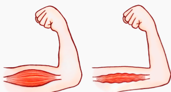 左:正常な上腕二頭筋(太く盛り上がった筋肉)、右:筋萎縮で細くなった上腕二頭筋の比較イラスト